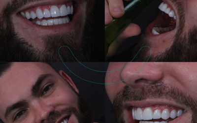 Em Brasília, Dr Rogério Duarte é especialista em transformação de sorrisos com lentes de contato dental